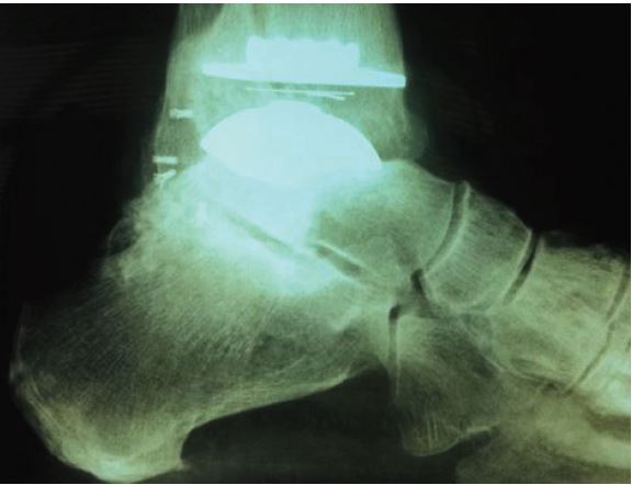 Total Ankle Replacement with the STAR Ankle System Penn